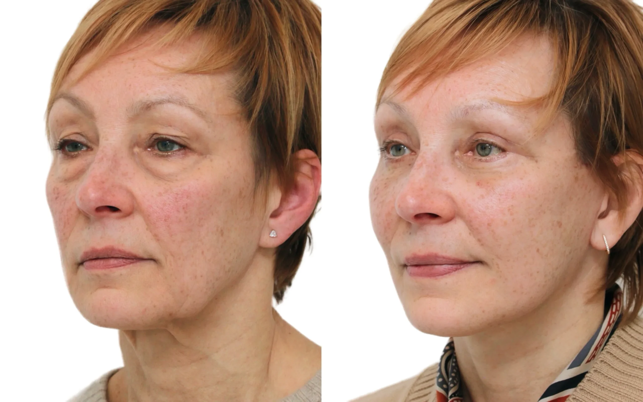 Eyelids – Lower Blepharoplasty
