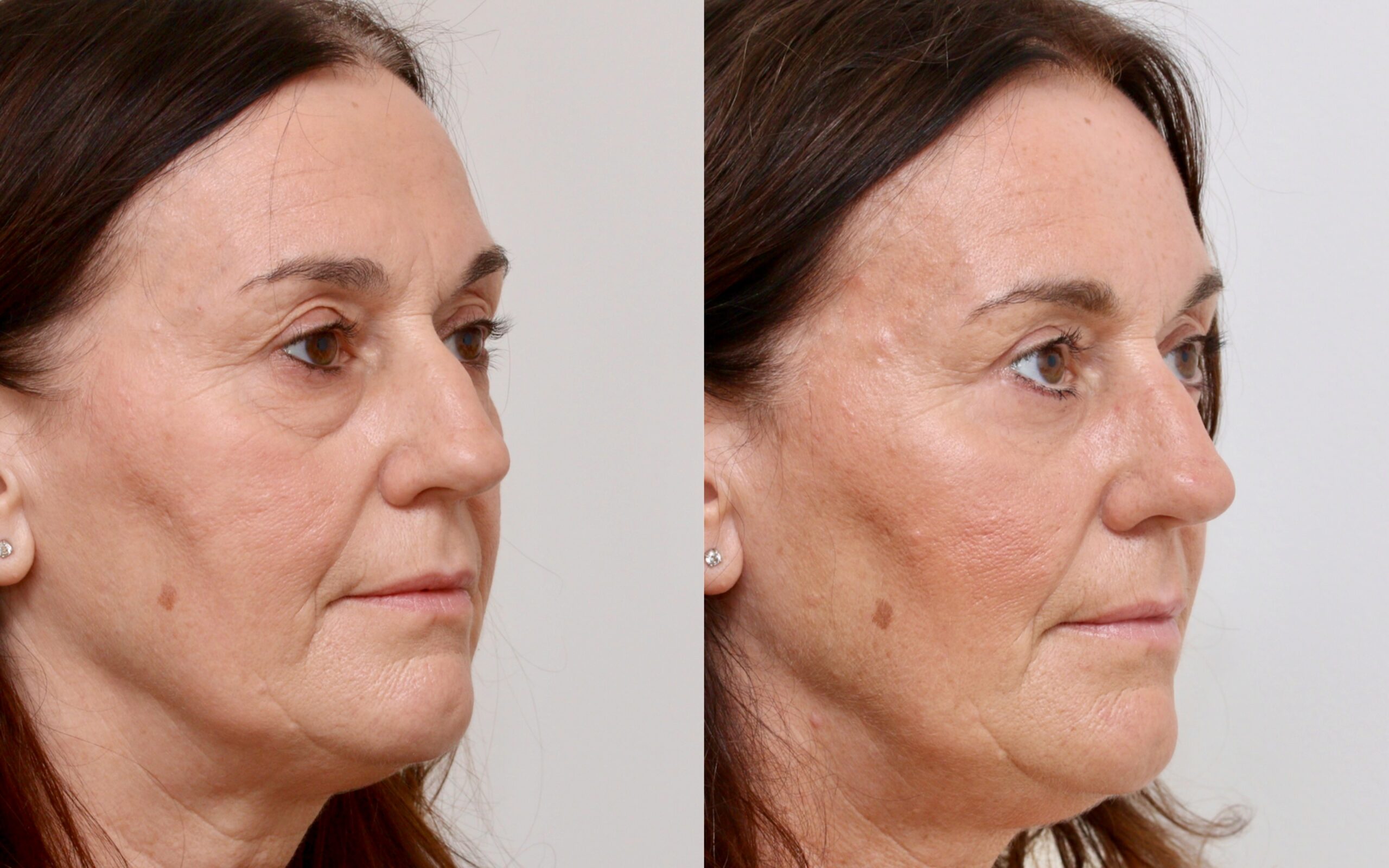 Eyelids – Lower Blepharoplasty