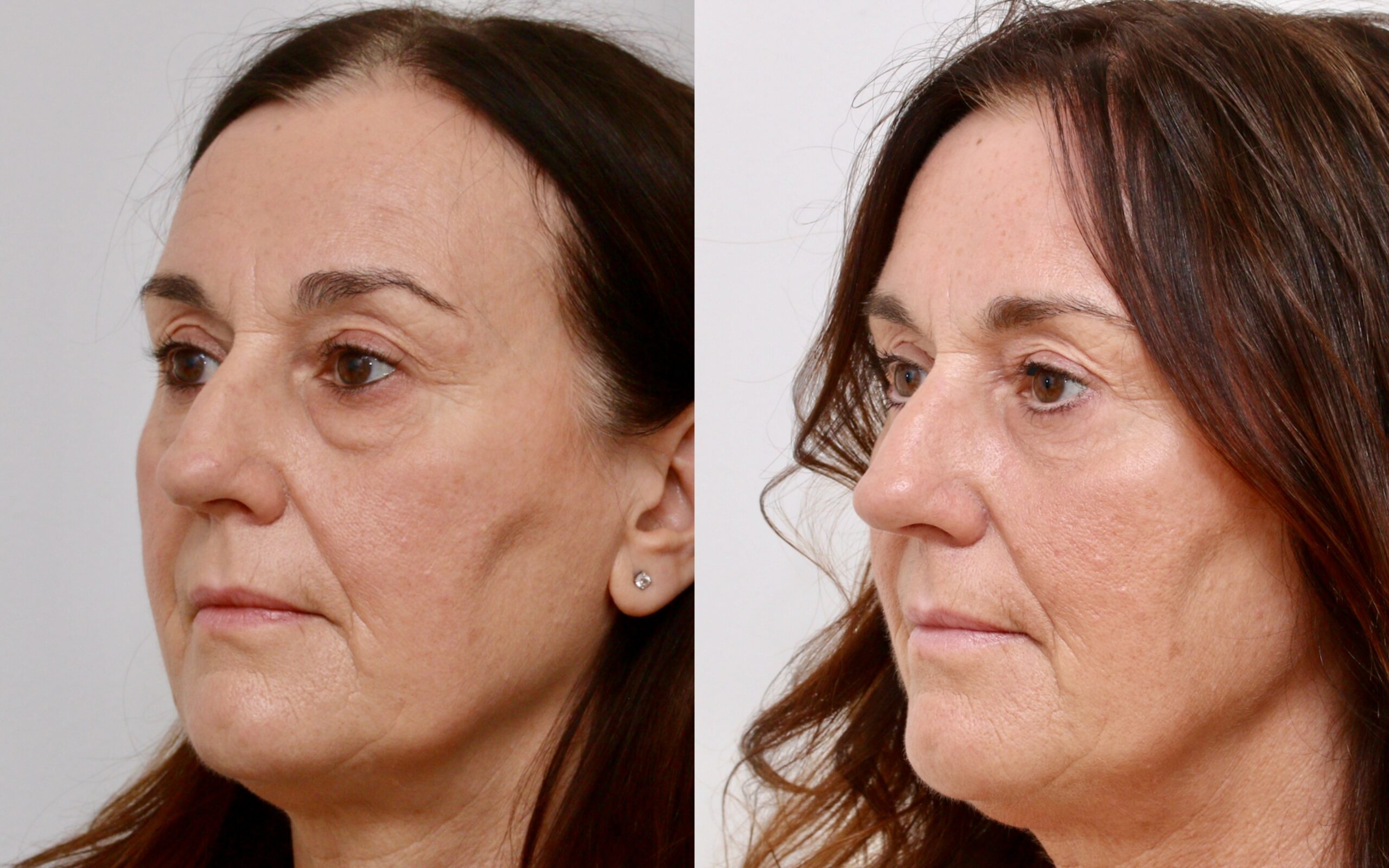 Eyelids – Lower Blepharoplasty
