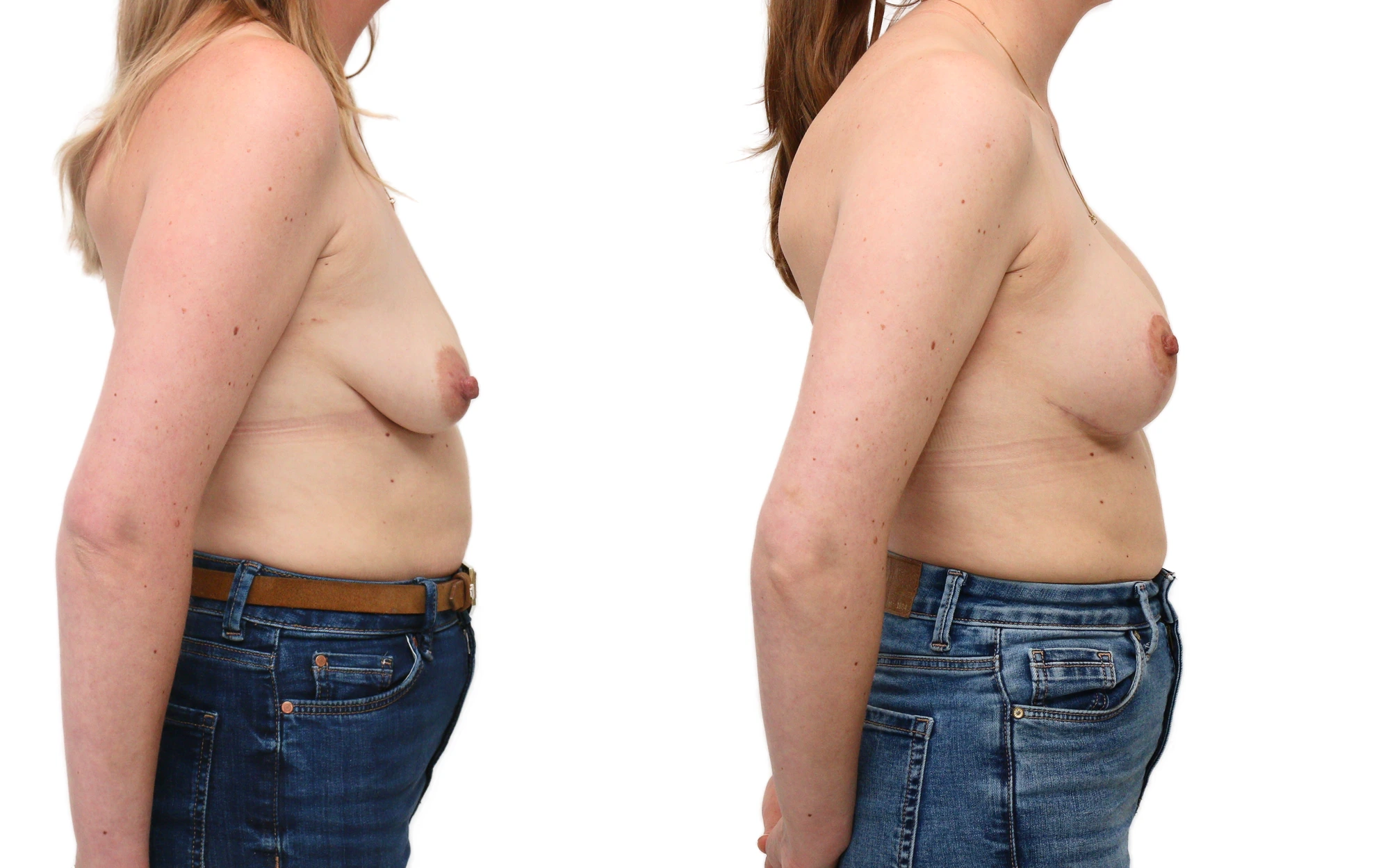 Breast uplift with implants