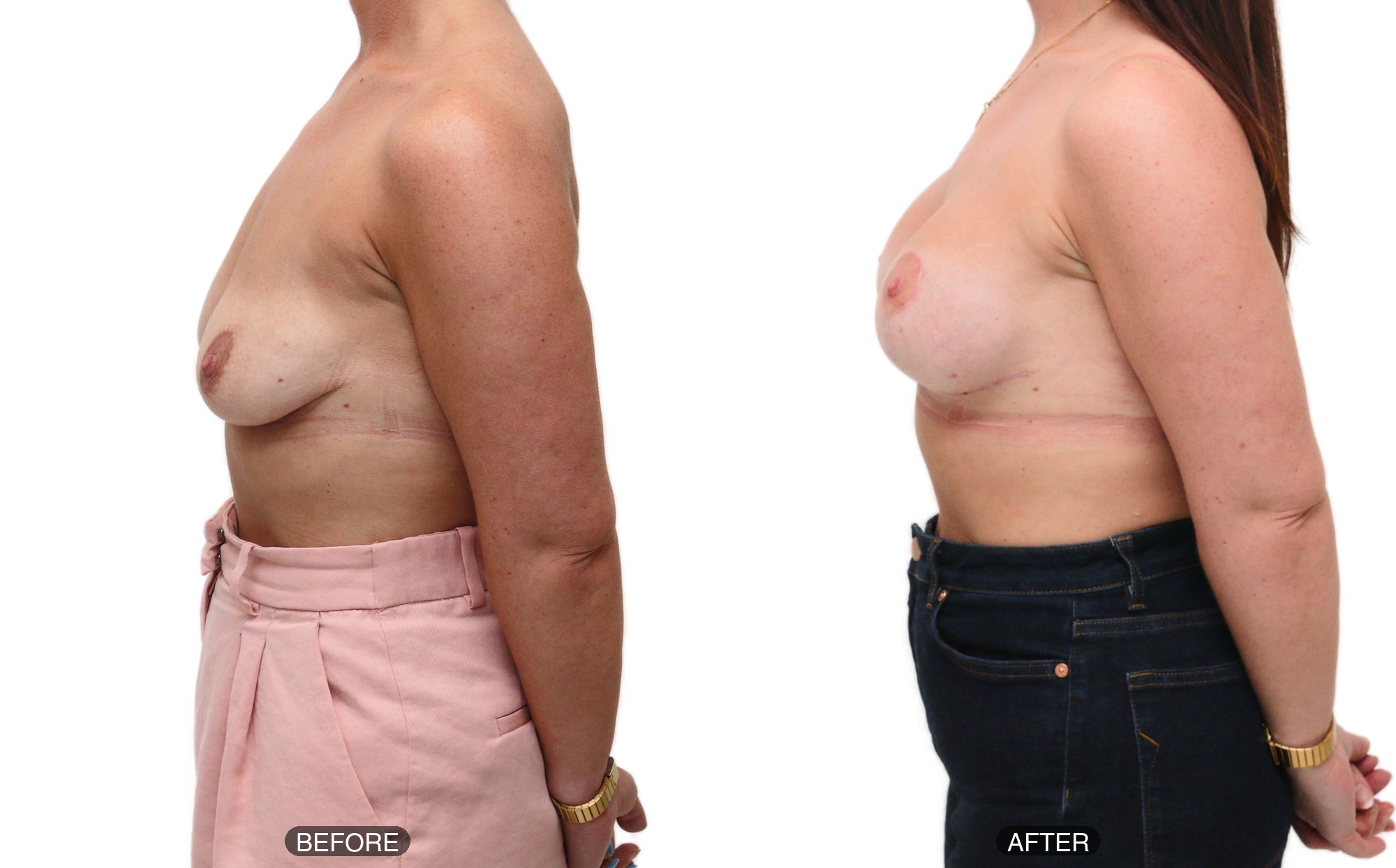 breast uplift with implants